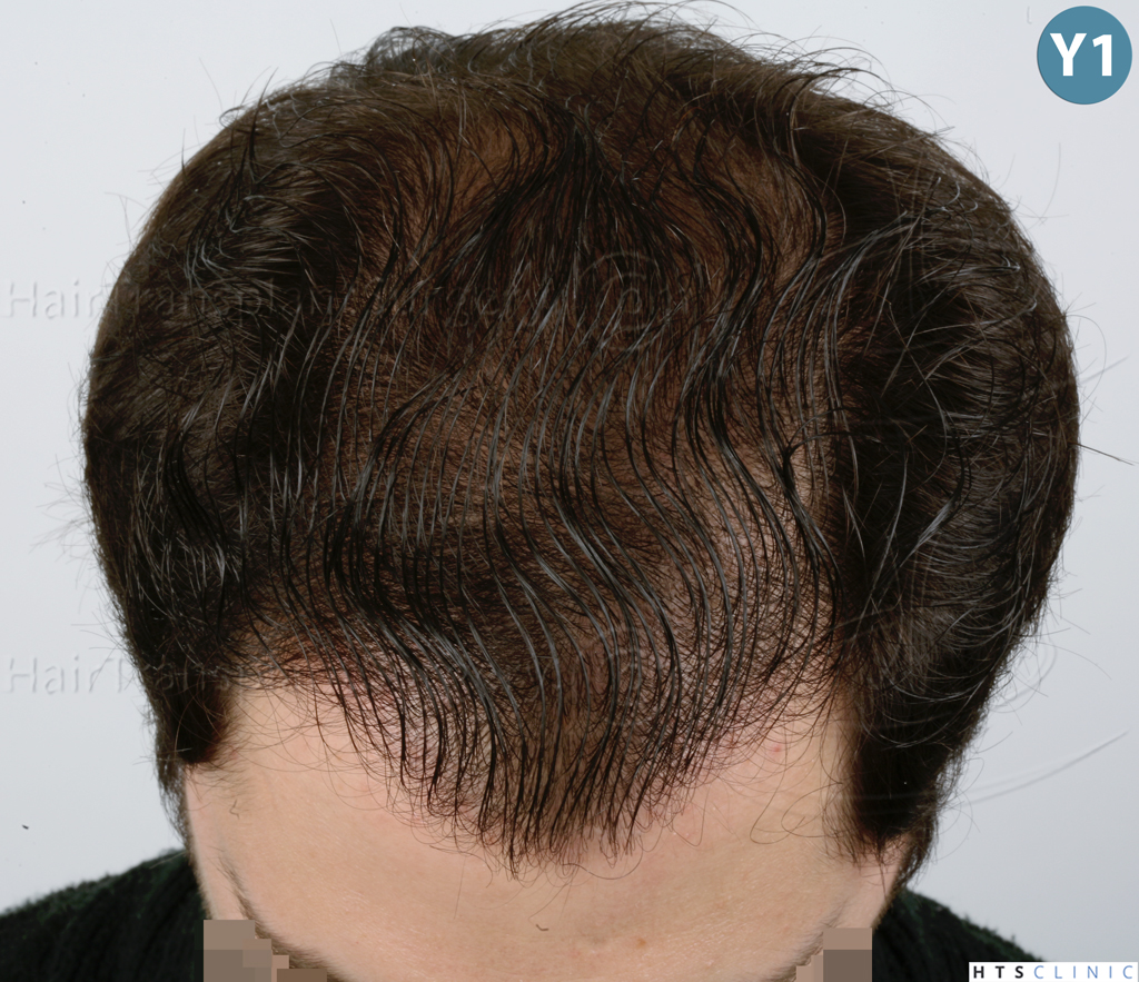 Dr.Devroye-HTS-clinic-3444-FUE-NW-V-32