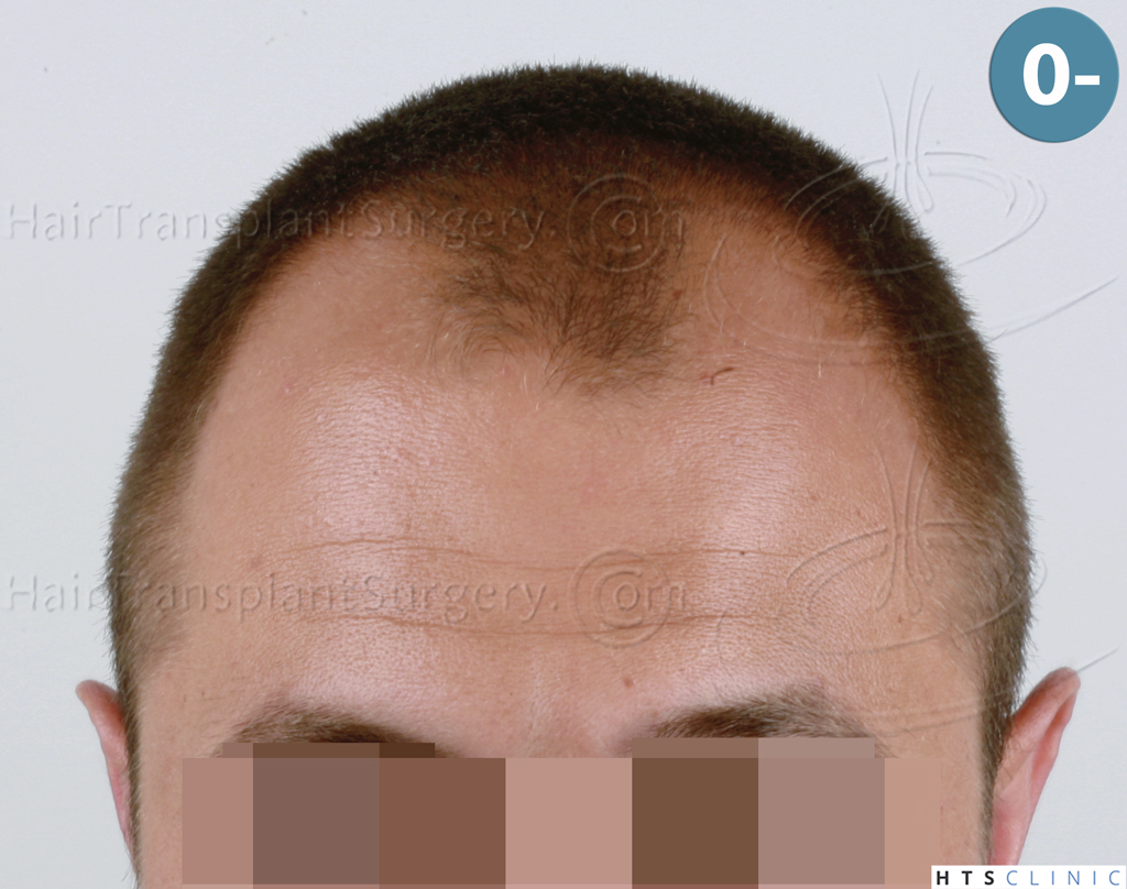 Dr.Devroye-HTS-Clinic-2671-FUE-NW-III-1.