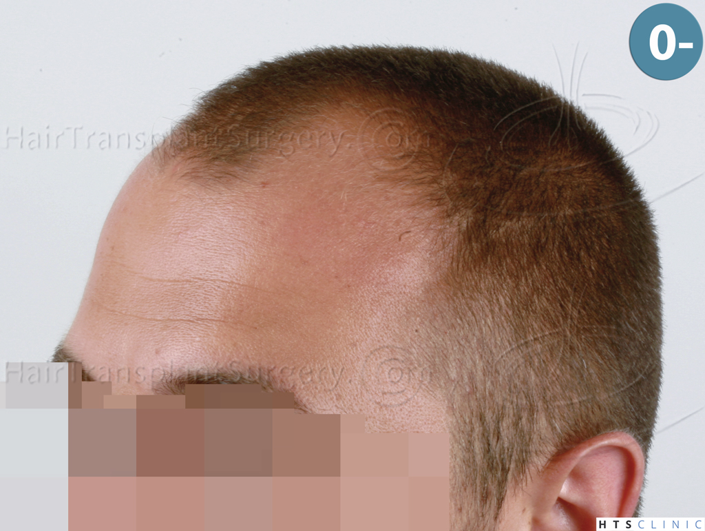 Dr.Devroye-HTS-Clinic-2671-FUE-NW-III-3.