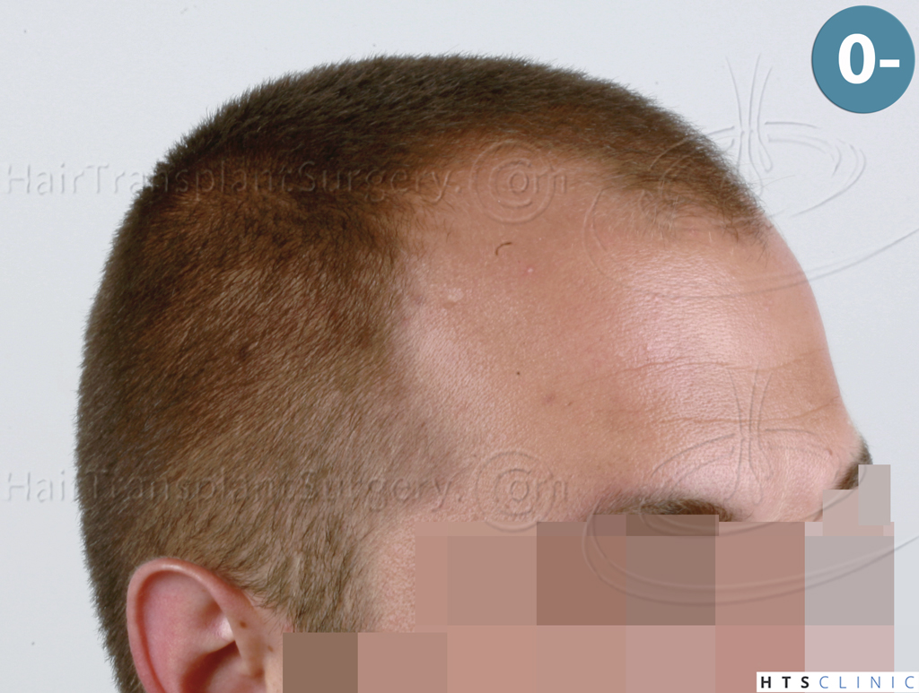 Dr.Devroye-HTS-Clinic-2671-FUE-NW-III-4.