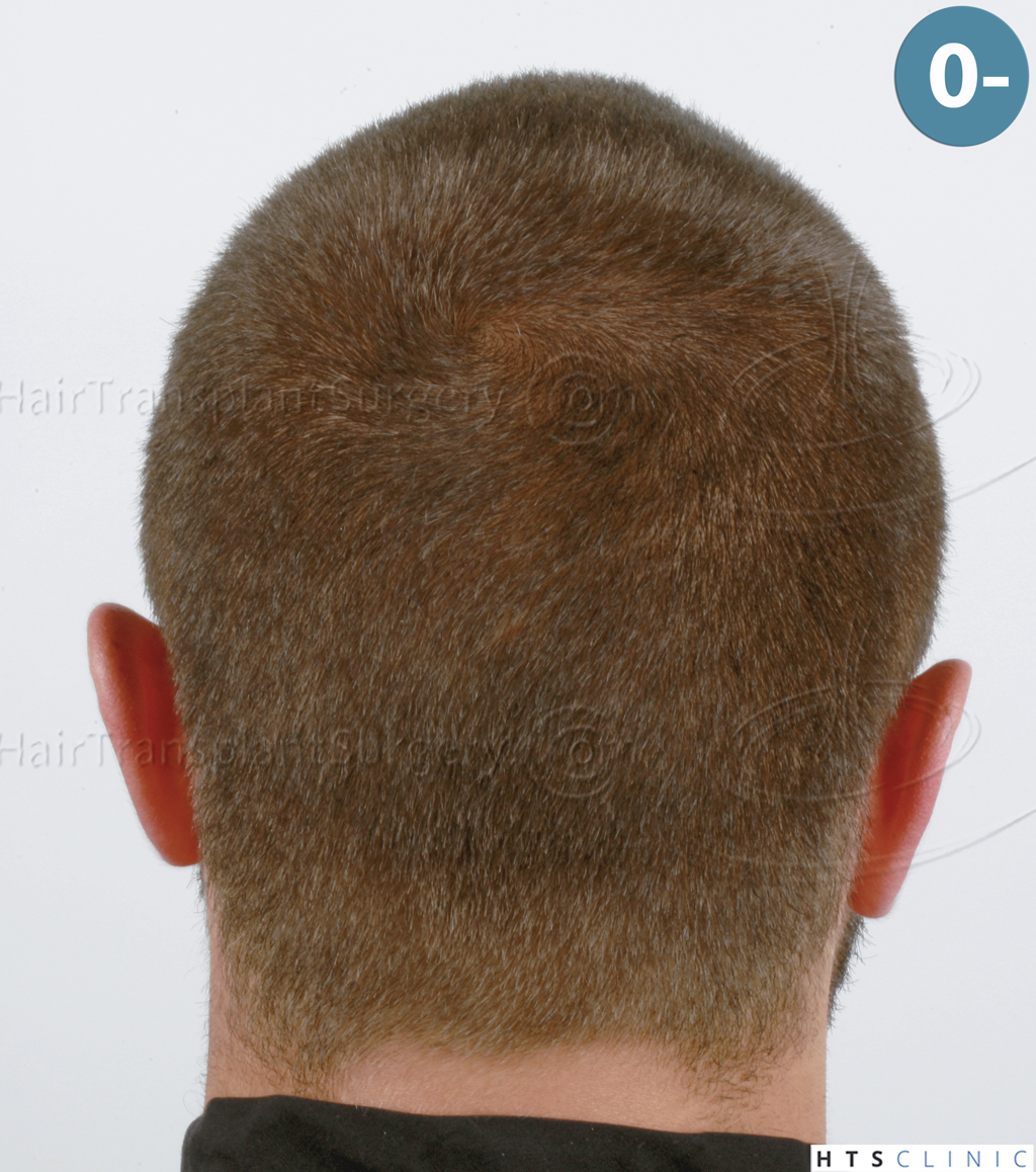 Dr.Devroye-HTS-Clinic-2671-FUE-NW-III-5