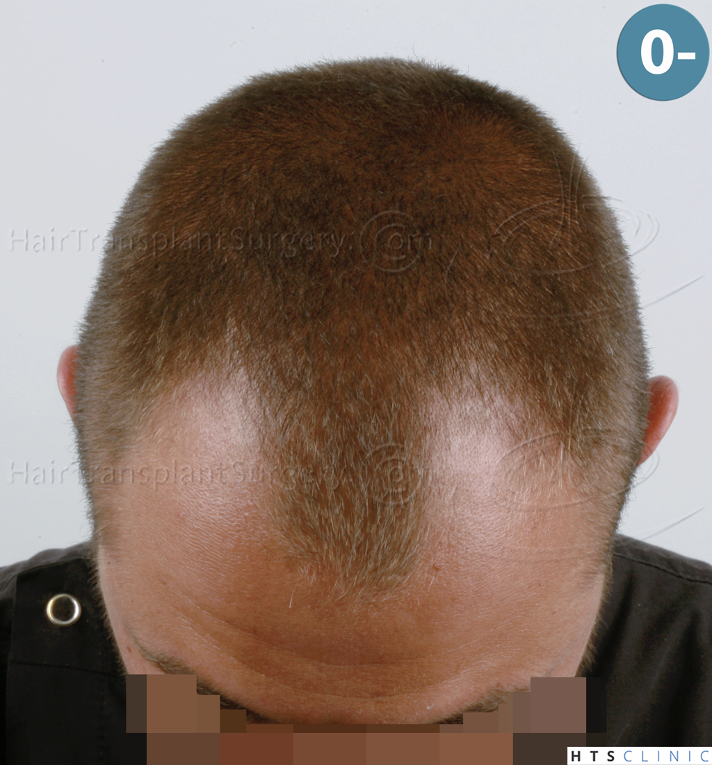 Dr.Devroye-HTS-Clinic-2671-FUE-NW-III-2.