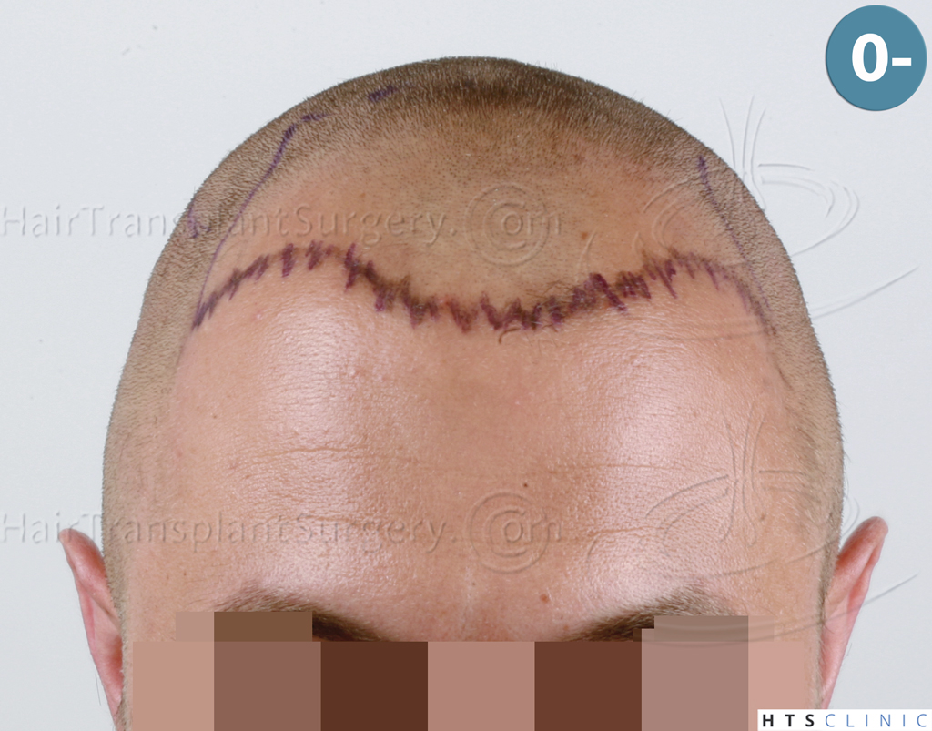 Dr.Devroye-HTS-Clinic-2671-FUE-NW-III-7.