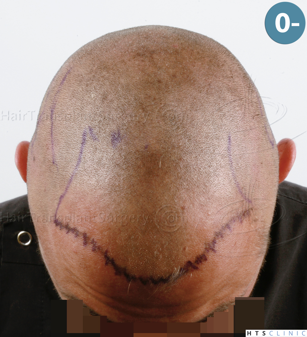 Dr.Devroye-HTS-Clinic-2671-FUE-NW-III-8.