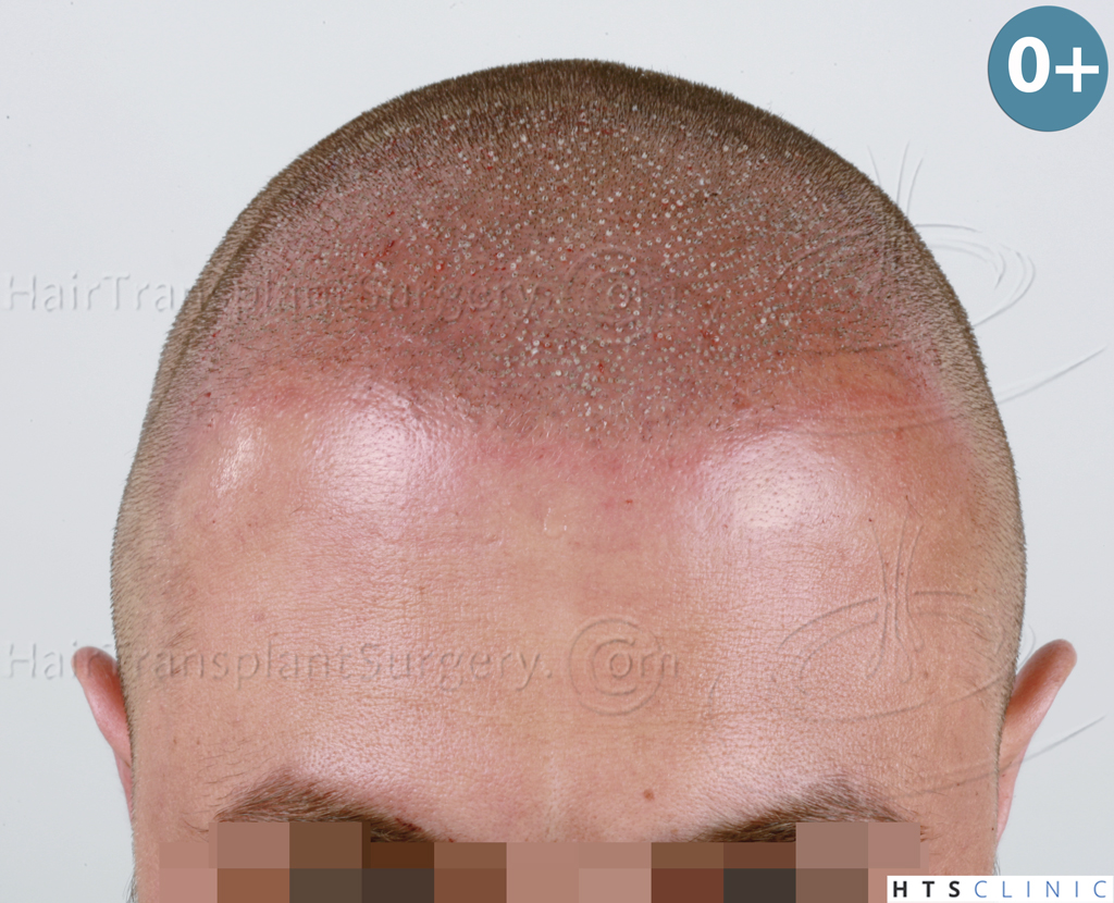 Dr.Devroye-HTS-Clinic-2671-FUE-NW-III-9.