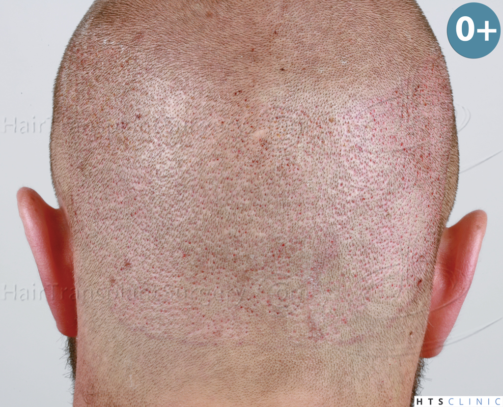 Dr.Devroye-HTS-Clinic-2671-FUE-NW-III-13