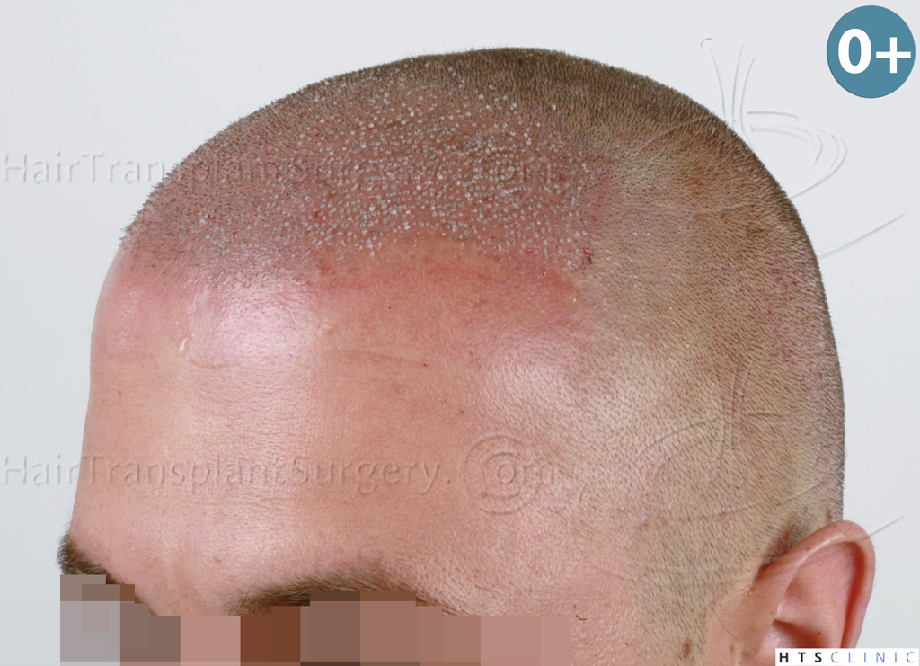 Dr.Devroye-HTS-Clinic-2671-FUE-NW-III-11