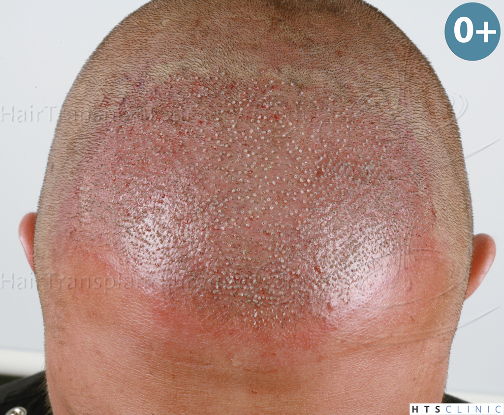 Dr.Devroye-HTS-Clinic-2671-FUE-NW-III-10