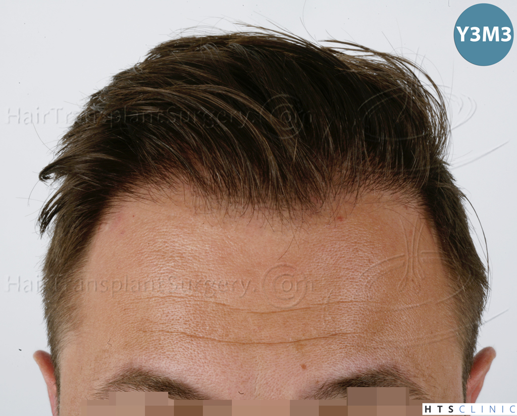 Dr.Devroye-HTS-Clinic-2671-FUE-NW-III-17