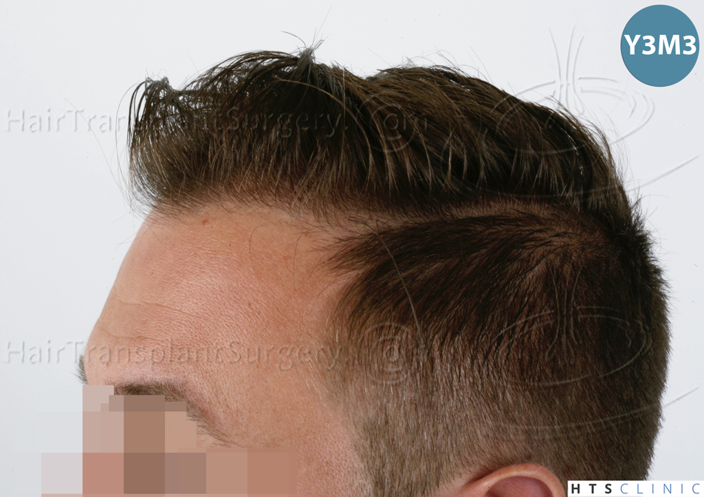 Dr.Devroye-HTS-Clinic-2671-FUE-NW-III-18