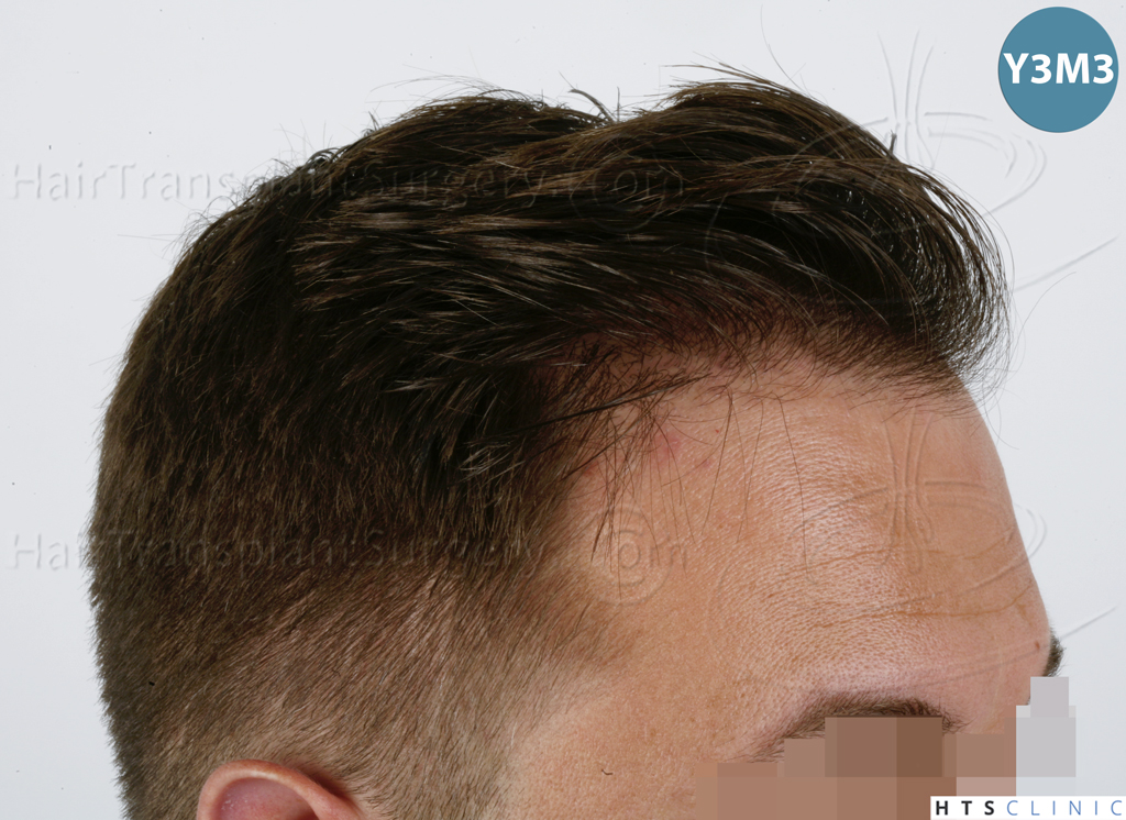 Dr.Devroye-HTS-Clinic-2671-FUE-NW-III-19