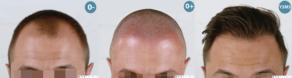 Dr.Devroye-HTS-Clinic-2671-FUE-NW-III-1-