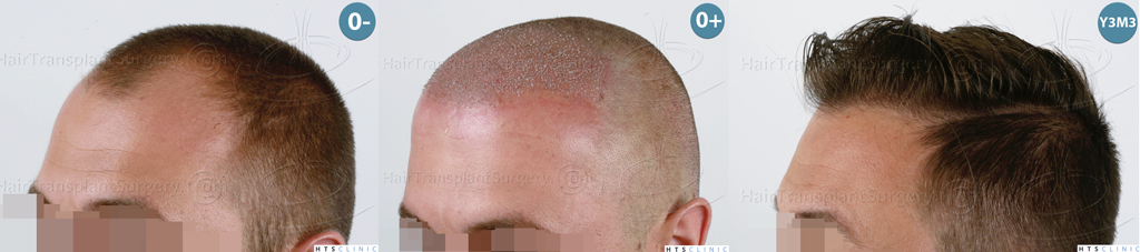 Dr.Devroye-HTS-Clinic-2671-FUE-NW-III-1-Montage2