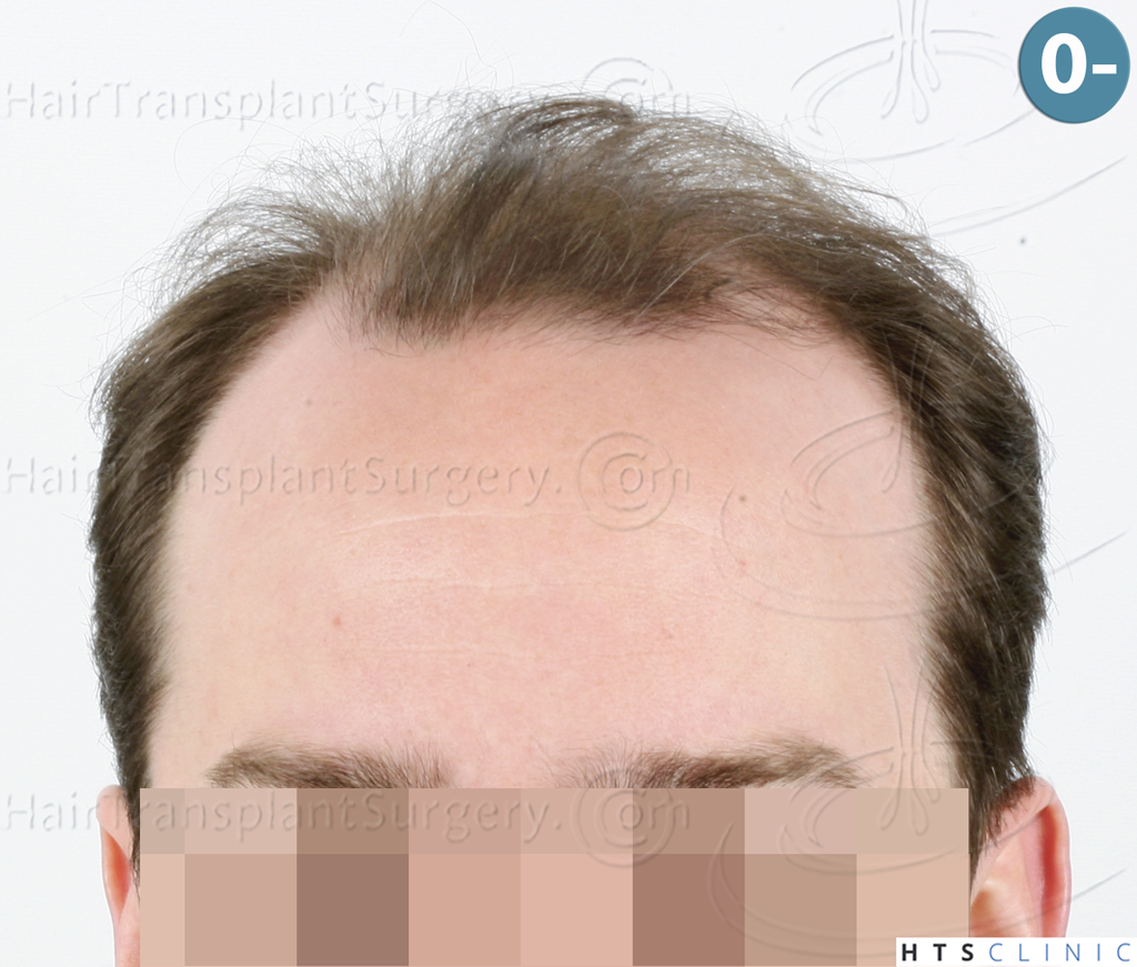 Dr.Devroye-HTS-Clinic-3878-FUE-NW-V-1