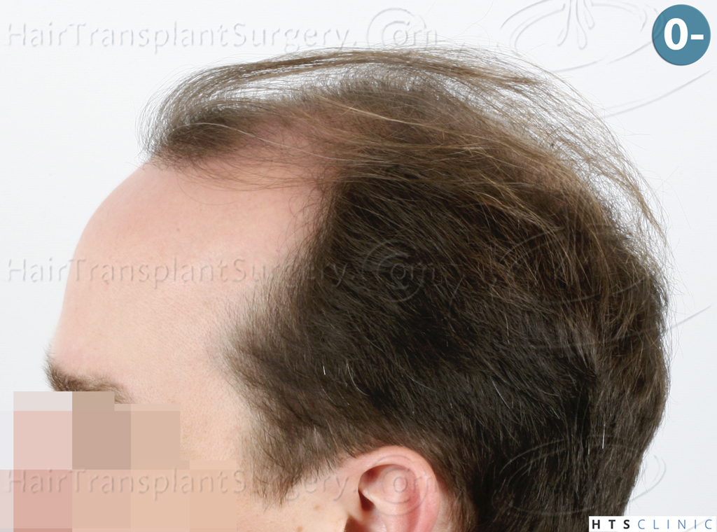 Dr.Devroye-HTS-Clinic-3878-FUE-NW-V-3