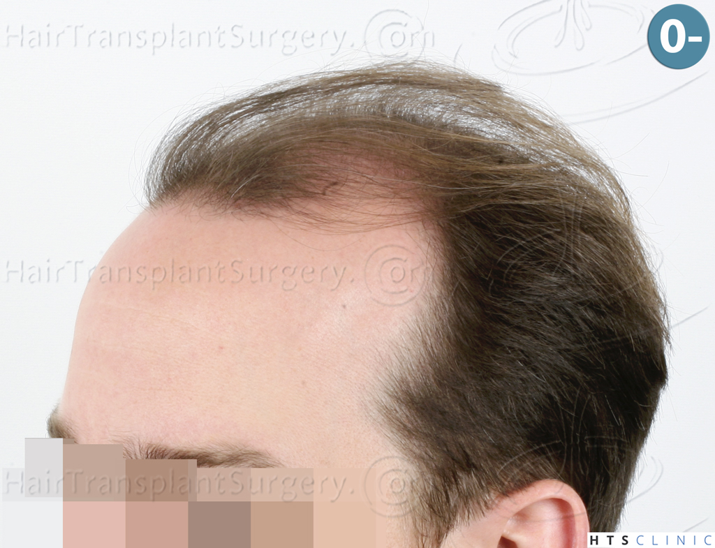 Dr.Devroye-HTS-Clinic-3878-FUE-NW-V-4