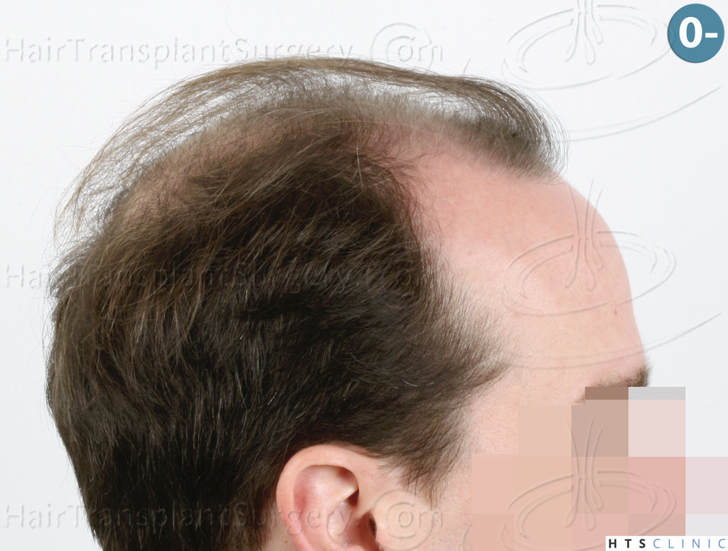 Dr.Devroye-HTS-Clinic-3878-FUE-NW-V-5