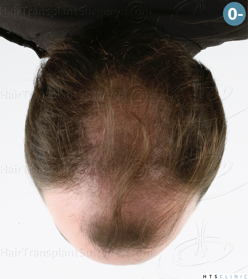 Dr.Devroye-HTS-Clinic-3878-FUE-NW-V-2.jpg