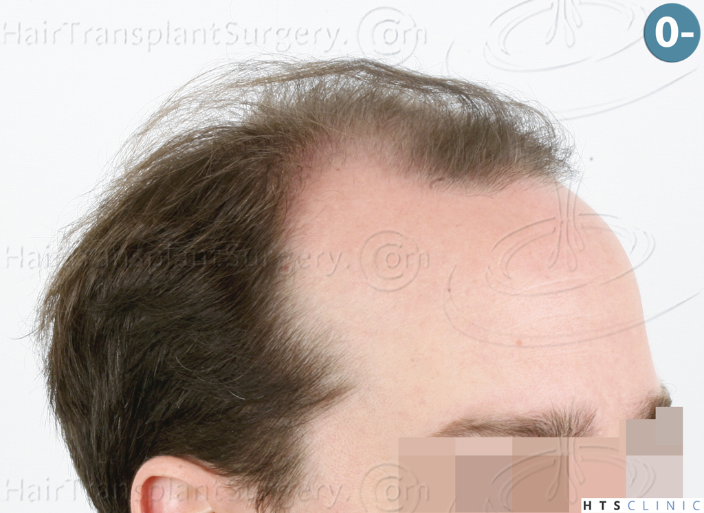 Dr.Devroye-HTS-Clinic-3878-FUE-NW-V-6.jpg
