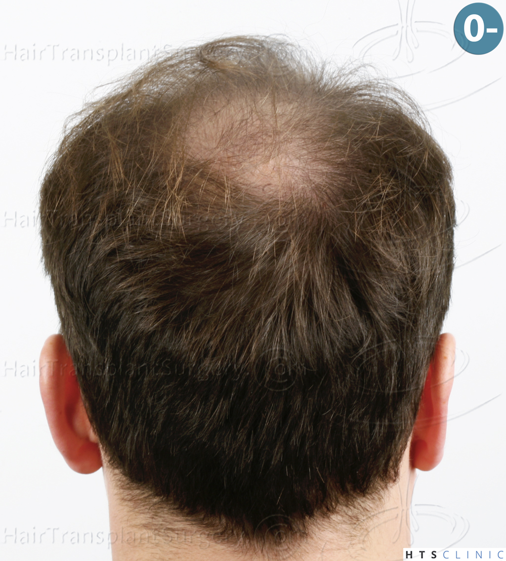 Dr.Devroye-HTS-Clinic-3878-FUE-NW-V-7