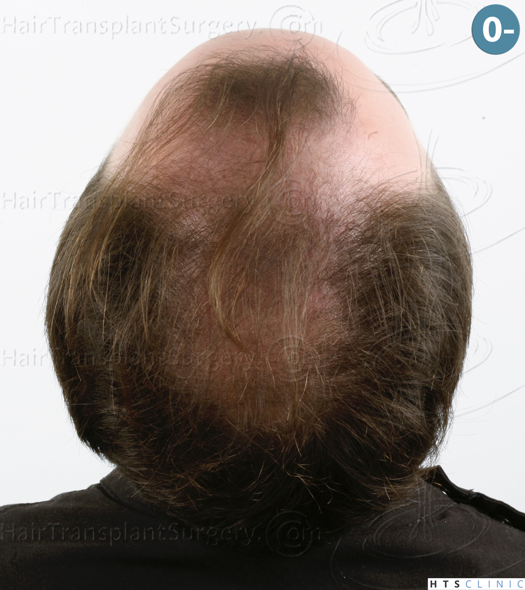 Dr.Devroye-HTS-Clinic-3878-FUE-NW-V-8.jpg