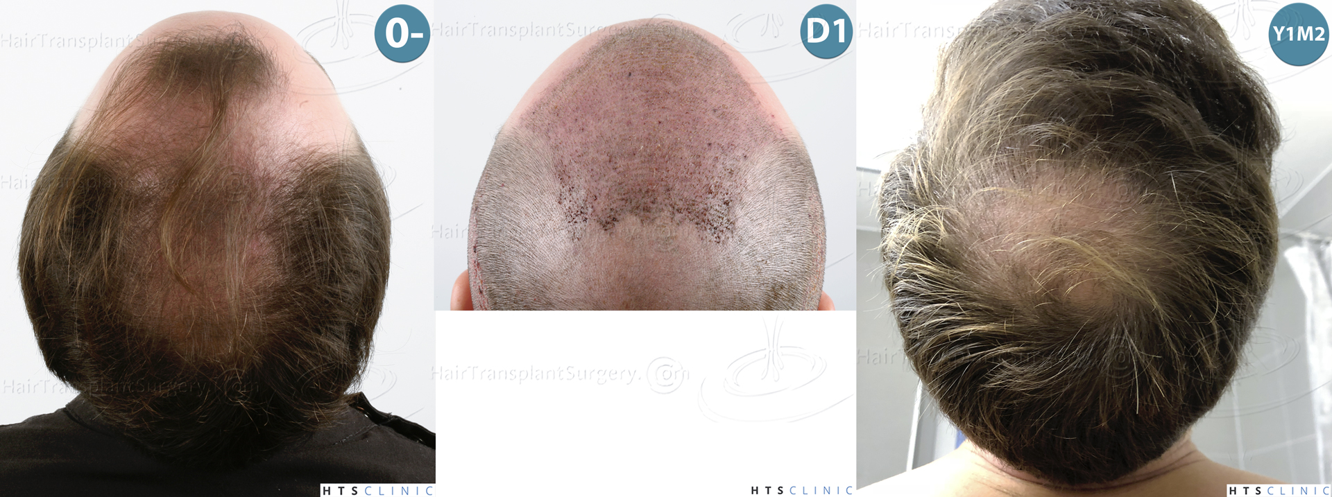 Dr.Devroye-HTS-Clinic-3878-FUE-NW-V-Montage-6