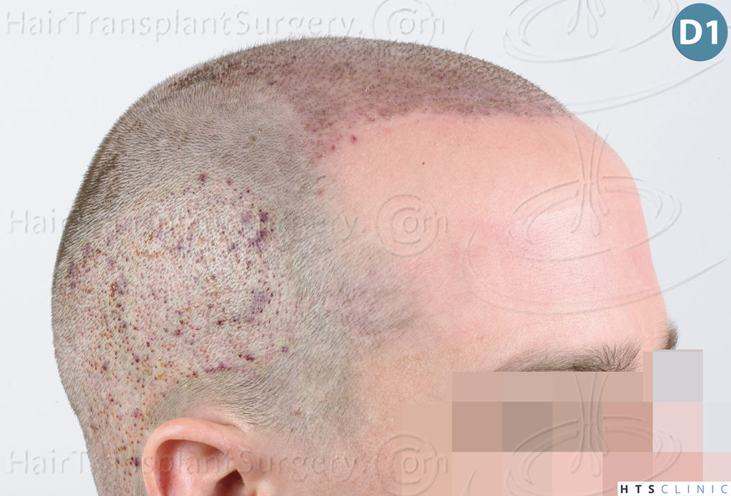 Dr.Devroye-HTS-Clinic-3878-FUE-NW-V-12