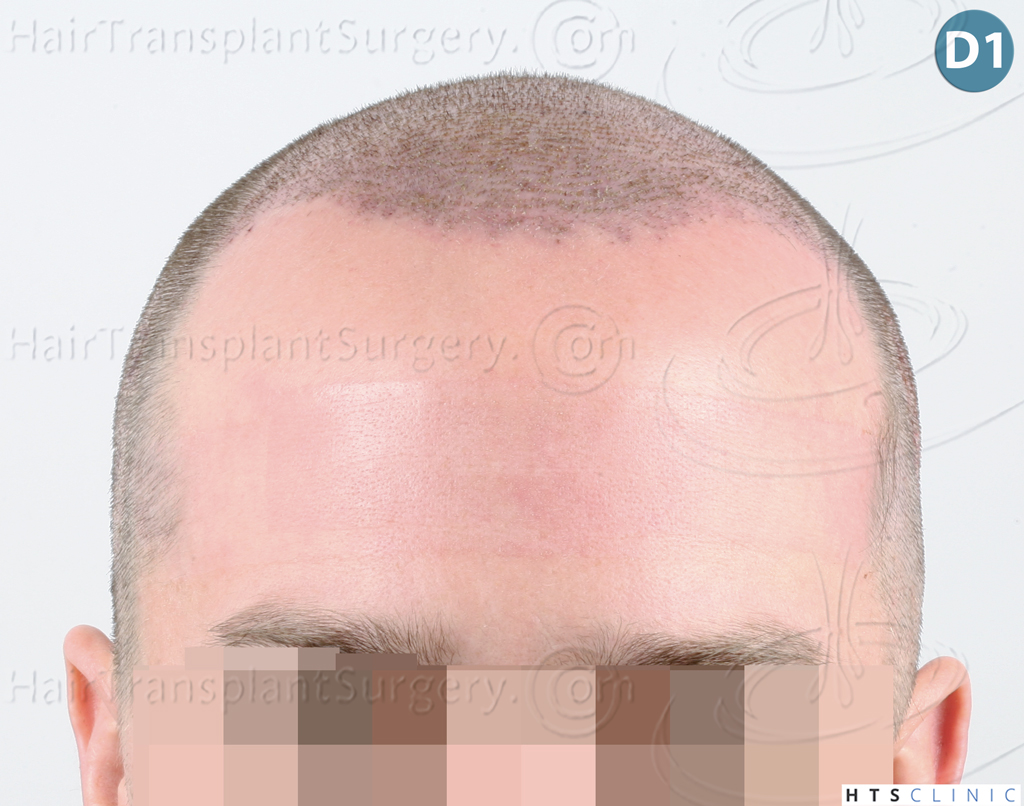 Dr.Devroye-HTS-Clinic-3878-FUE-NW-V-9