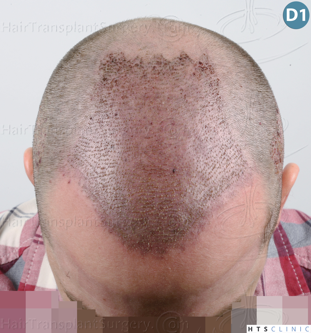 Dr.Devroye-HTS-Clinic-3878-FUE-NW-V-10