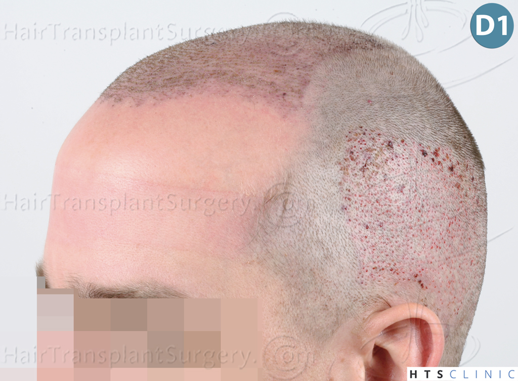 Dr.Devroye-HTS-Clinic-3878-FUE-NW-V-11.jpg