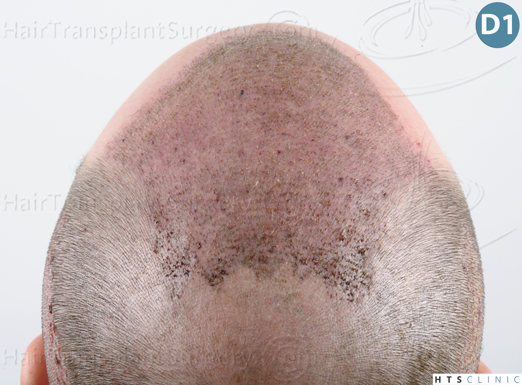 Dr.Devroye-HTS-Clinic-3878-FUE-NW-V-14.jpg