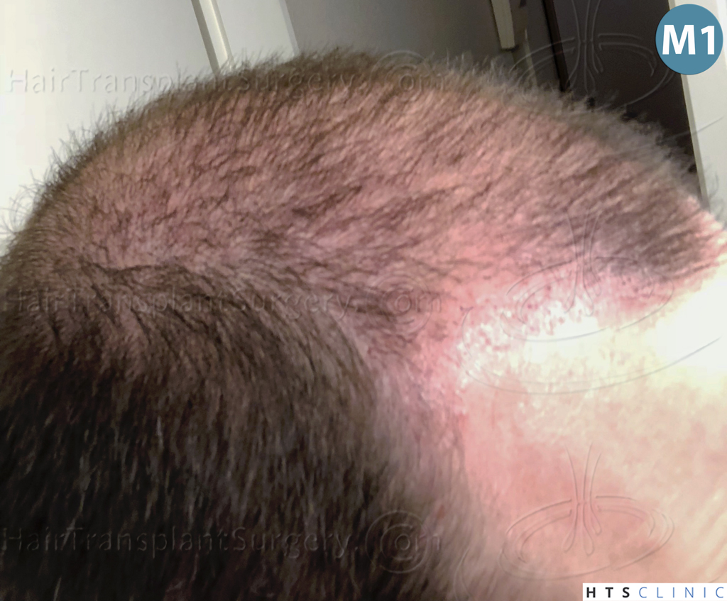 Dr.Devroye-HTS-Clinic-3878-FUE-NW-V-18.jpg