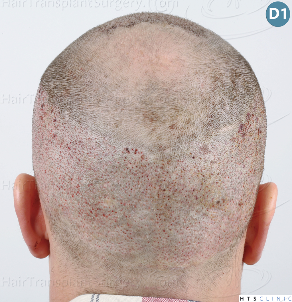 Dr.Devroye-HTS-Clinic-3878-FUE-NW-V-13