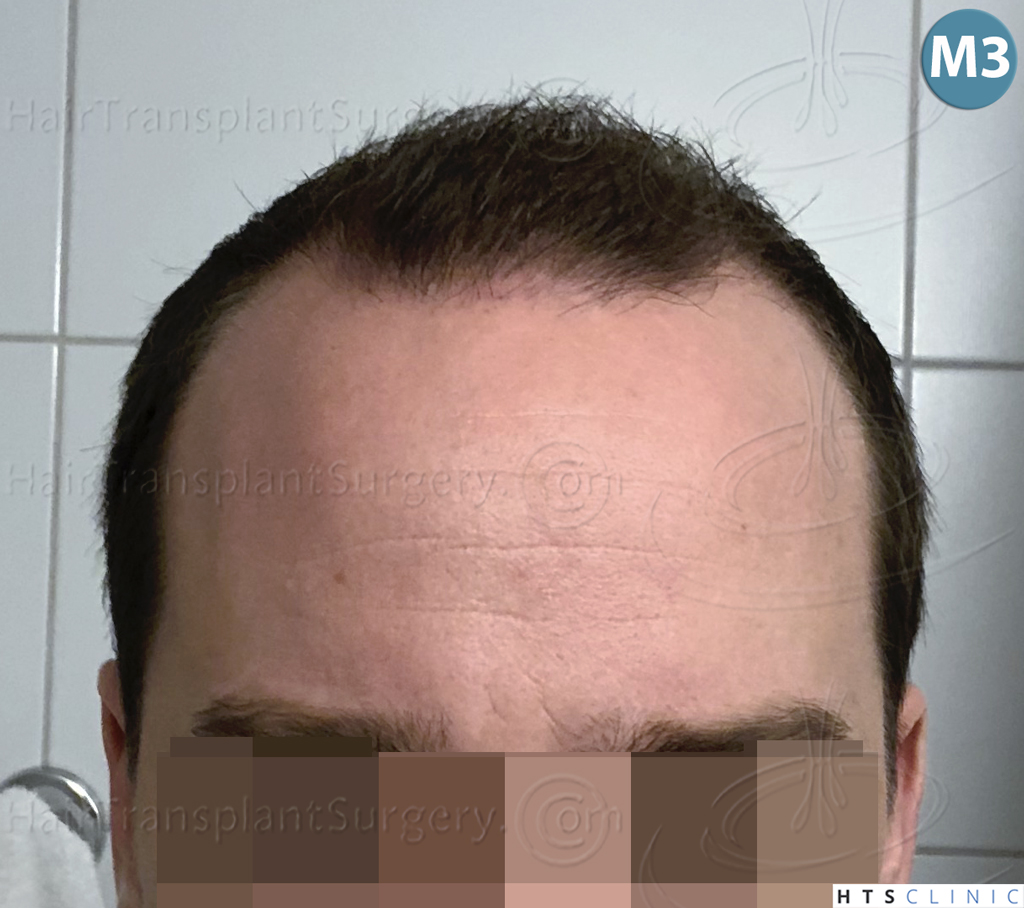 Dr.Devroye-HTS-Clinic-3878-FUE-NW-V-19