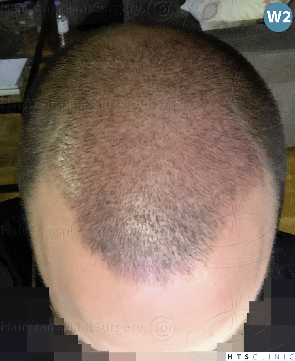 Dr.Devroye-HTS-Clinic-3878-FUE-NW-V-15.jpg