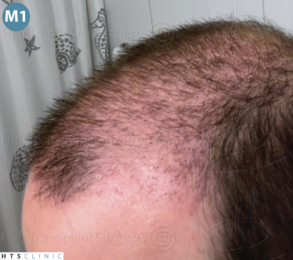 Dr.Devroye-HTS-Clinic-3878-FUE-NW-V-17.jpg