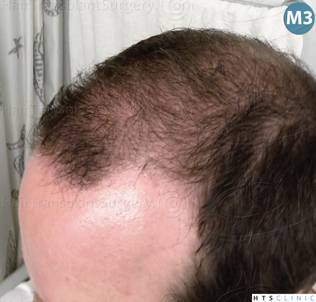 Dr.Devroye-HTS-Clinic-3878-FUE-NW-V-20