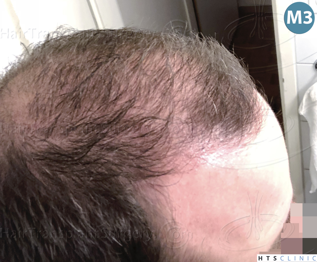 Dr.Devroye-HTS-Clinic-3878-FUE-NW-V-21