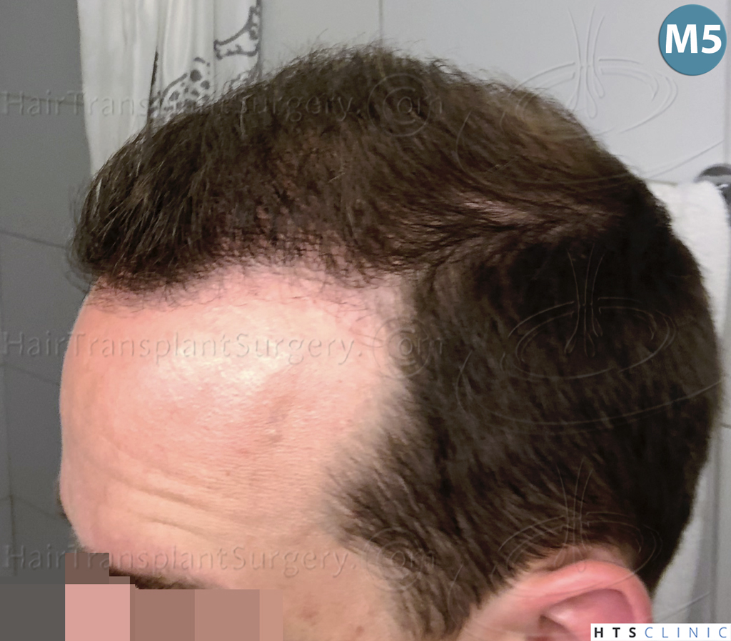 Dr.Devroye-HTS-Clinic-3878-FUE-NW-V-22