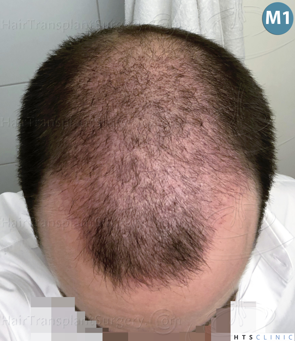 Dr.Devroye-HTS-Clinic-3878-FUE-NW-V-16