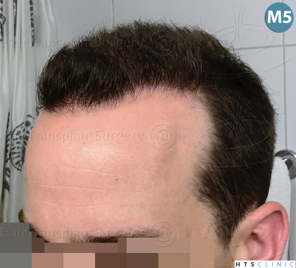 Dr.Devroye-HTS-Clinic-3878-FUE-NW-V-23