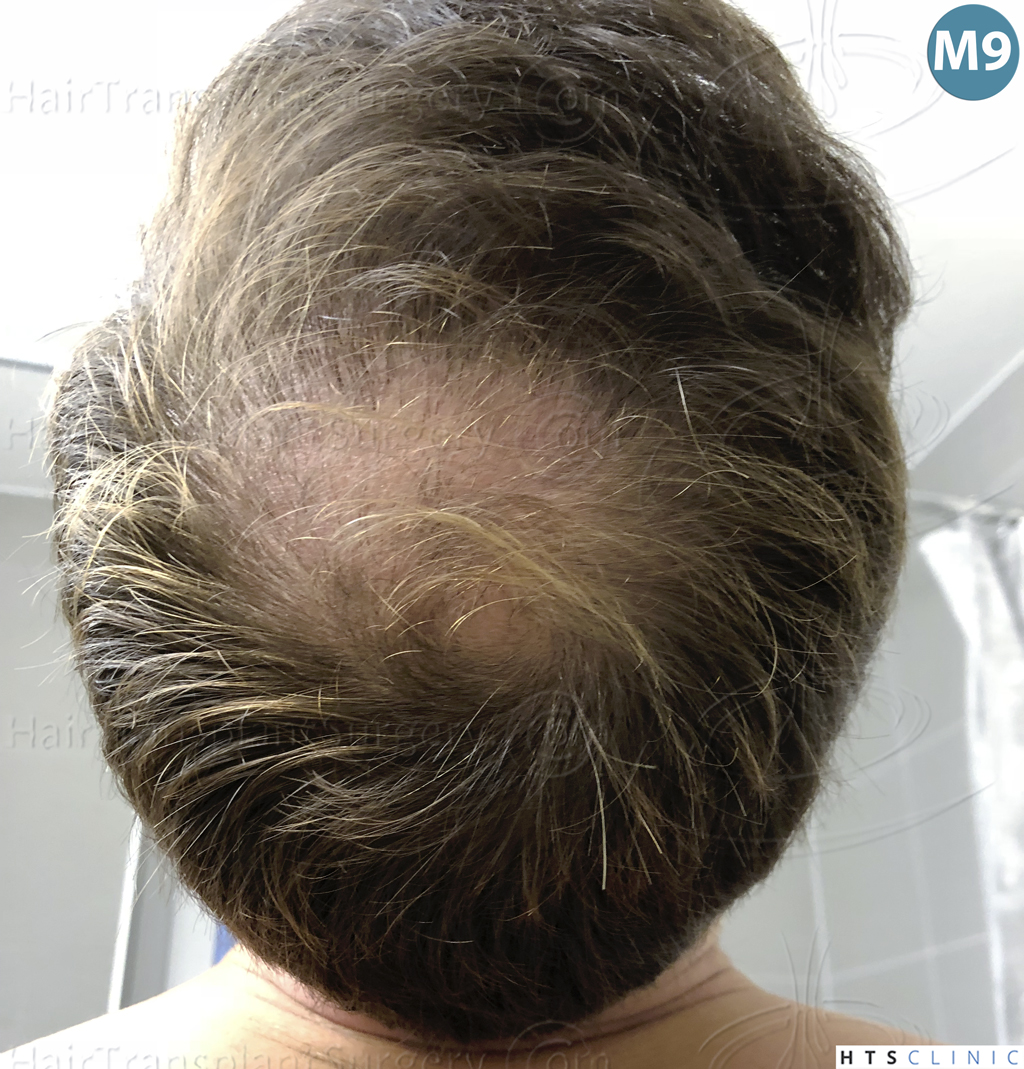 Dr.Devroye-HTS-Clinic-3878-FUE-NW-V-25