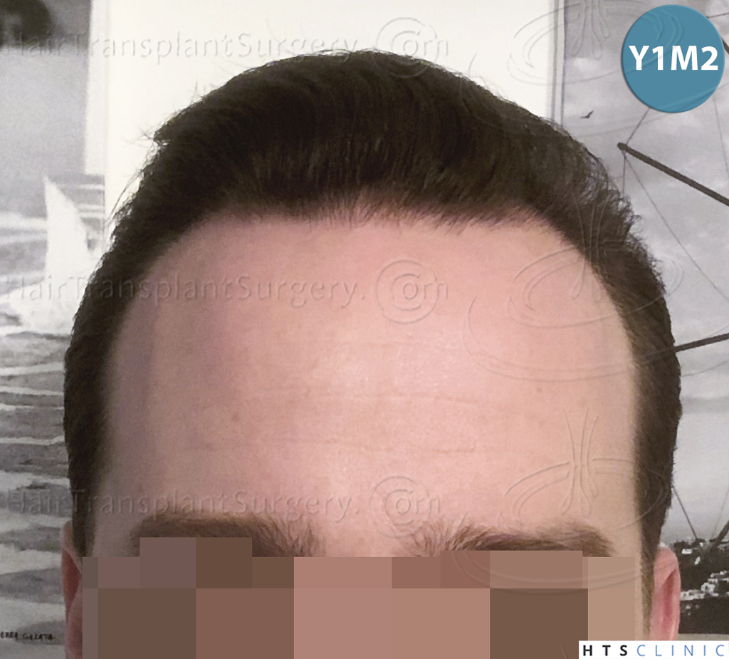 Dr.Devroye-HTS-Clinic-3878-FUE-NW-V-26