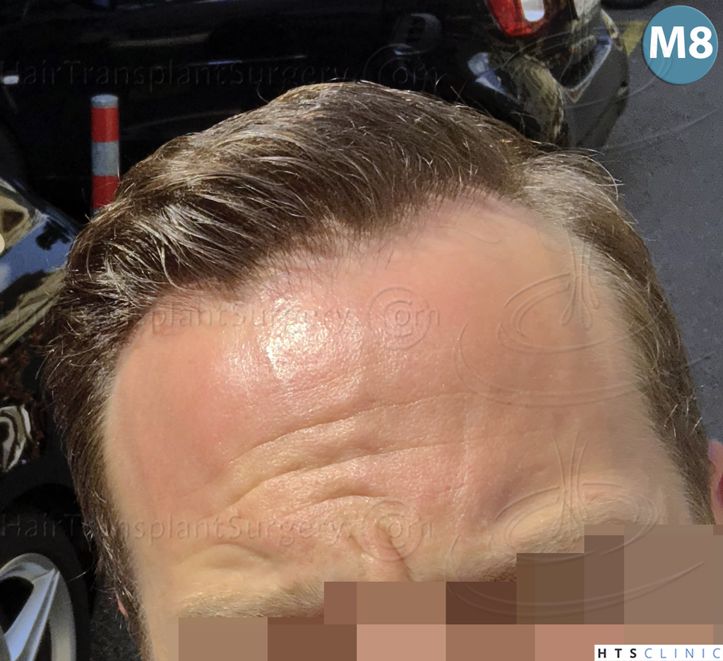 Dr.Devroye-HTS-Clinic-3878-FUE-NW-V-24.jpg