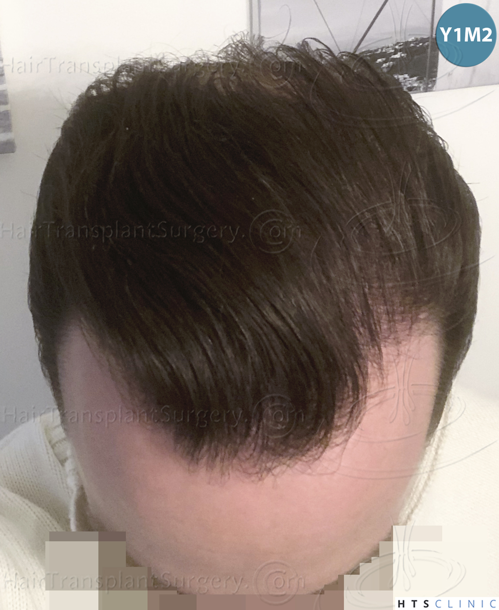 Dr.Devroye-HTS-Clinic-3878-FUE-NW-V-27