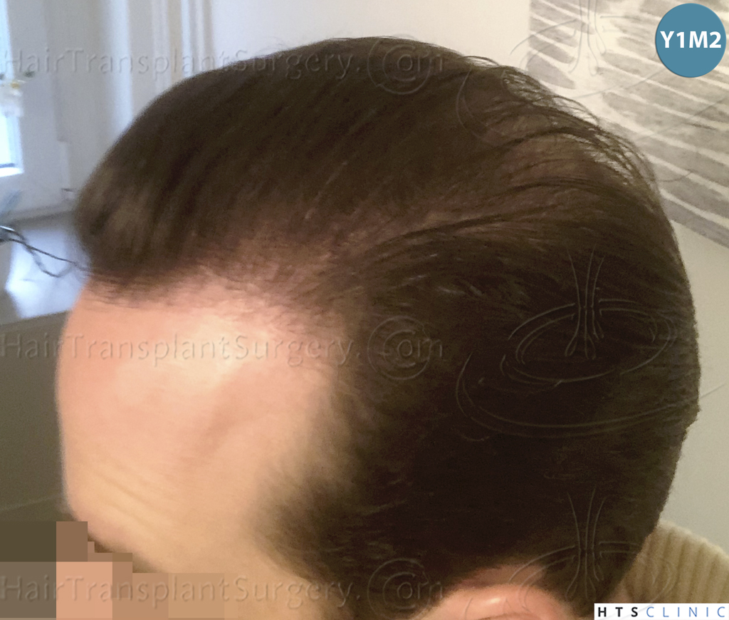 Dr.Devroye-HTS-Clinic-3878-FUE-NW-V-28