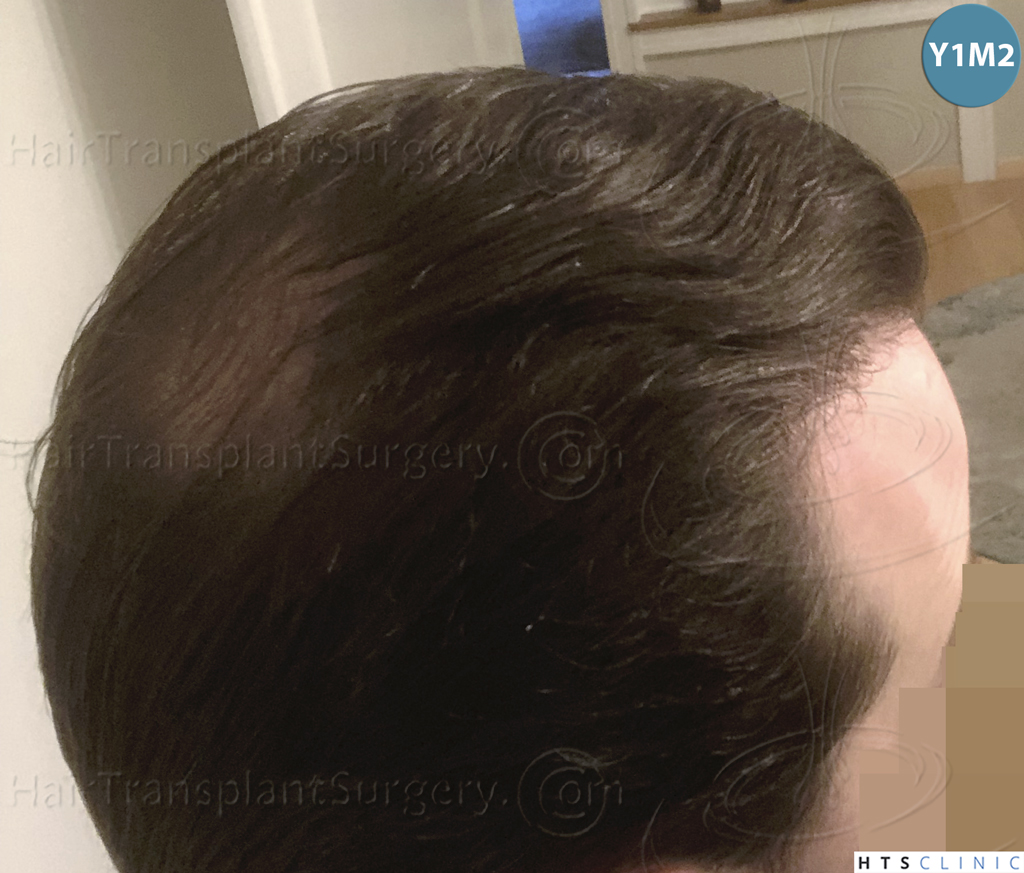 Dr.Devroye-HTS-Clinic-3878-FUE-NW-V-29