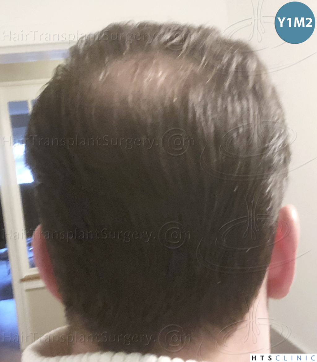 Dr.Devroye-HTS-Clinic-3878-FUE-NW-V-30