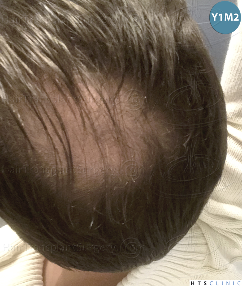 Dr.Devroye-HTS-Clinic-3878-FUE-NW-V-31.jpg