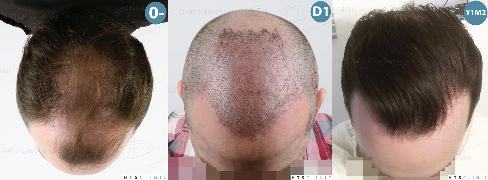 Dr.Devroye-HTS-Clinic-3878-FUE-NW-V-Mont